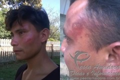 Indio da tribo Tora-Munduruku com ematomas na cabeca