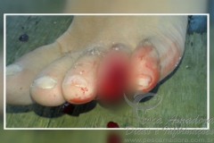 Jovem atacado por piranhas em Caldas Novas-GO 01